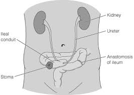 Hematuria can be caused by a. Https Www Baus Org Uk Userfiles Pages Files Patients Leaflets Ileal 20conduit Pdf