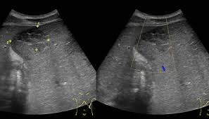 Image result for Splenic Abscess