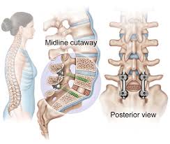 exercising after a spinal fusion