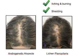 Because different conditions can cause hair loss, a person may need to see a doctor that is a dermatologist or an endocrinologist for treatment. Can I Have A Hair Transplant Donovan Hair Clinic