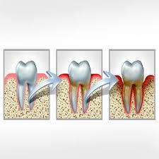 Image result for Periodontal Abscess