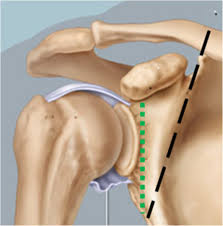 Subscapularis arises, as the name suggests, from the undersurface of the scapula and is an internal rotator of the shoulder. Shoulder Girdle Resection Surgical Technique Modification And Introduction Of A New Classification System World Journal Of Surgical Oncology Full Text