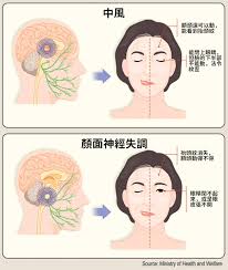 马来西亚 malaysia | en 简. è…¦ä¸­é¢¨æœ‰4 å¤§å‰å…† æ³¨æ„3 ç¨®æšˆçœ©ç—‡ç‹€ æœ‰ç•°ç‹€å°±é€é†« Hehoå¥åº·