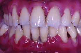 Early symptoms causes stages & cost to get rid of periodontal inflammation. Periodontitis Clinical Appearance In A 22 Year Old Man With Poorly Download Scientific Diagram