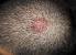 Cancer Pimples On Head