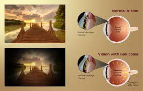 Residents and fellows contest rules | international ophthalmologists contest rules. File Depiction Of Vision For A Glaucoma Patient Png Wikipedia