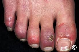 Image result for Chilblains
