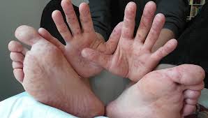 Young woman visiting male doctor dermatologist. Hand Foot And Mouth Disease Signs Symptoms And Treatment Vital Record