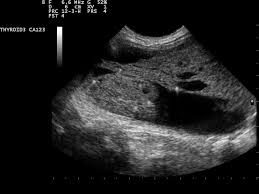 The reason is that small, nonpalpable ultrasound abnormalities are very common in people without evidence of thyroid disease. Thyroid Nodule Wikipedia