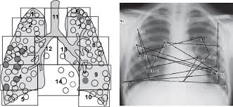 This pericardium is attached to the diaphragm, spinal column and other parts via strong ligaments. This Shows How The Chest Images Were Divided Into The 14 Zones To Download Scientific Diagram