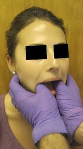 Clinical Importance of Morphology and Nomenclature of Distal Attachment of  Temporalis Tendon