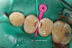 How long does it take to fill a cavity between teeth. How Long Does It Take To Fill A Cavity Between Teeth Teethwalls