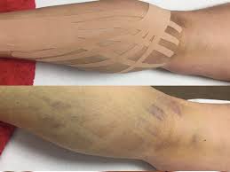 Image result for Taping for Soleus and Achilles