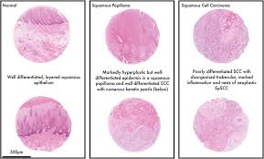 A squamous cell carcinoma is a malignant tumor in the epidermal layer of a dog's skin. Equine Penile Squamous Cell Carcinoma Expression Of Biomarker Proteins And Ecpv2 Scientific Reports