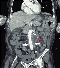 Image result for CT Intravenous Contrast