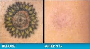 The selling price is in the $$ to $$ range. Best Tattoo Removal Creams Reviews Guides 2021 Guy Leta Tooer