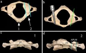 In anatomy, the atlas (c1) is the most superior (first) cervical vertebra of the spine and is located in the neck. Macerated Bone Specimen Of The Atlas Vertebra A Shows Vertebra From Download Scientific Diagram