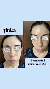5ta sesion de tratamiento MAT, se puede observar una piel mas luminos, mas  tersa y suave.
