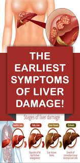 The Earliest Symptoms Of Liver Damage In 2020 Liver Health Liver Failure Liver Location