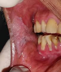 Drooling can be caused by excess production of saliva, inability to retain saliva within the mouth (incontinence of saliva), or problems with swallowing (dysphagia or odynophagia). Tobacco Related Oral Cancer The Bmj