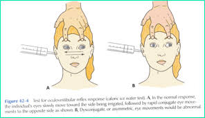 Image result for Oculovestibular Testing