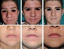 Papulopustular rosacea, topical ivermectin, metronidazole, azelaic acid, topical. Ivermectin Therapy For Papulopustular Rosacea And Periorificial Dermatitis In Children A Series Of 15 Cases Journal Of The American Academy Of Dermatology