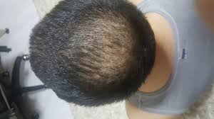 99 ($15.99/count) 5% coupon applied at checkout. Hair Transplant Results Before And After Hlc Hairline Clinic