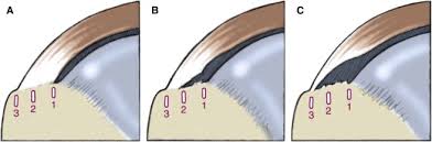 A New Arthroscopic Classification Of Articular Sided Supraspinatus Footprint Lesions A Prospective Comparison With Snyder S And Ellman S Classification Journal Of Shoulder And Elbow Surgery