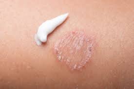 How To Cure Ringworm Health Essentials From Cleveland Clinic Ringworm is a fungal infection that causes a rash. how to cure ringworm health