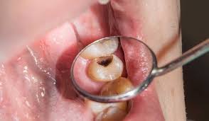 Tooth sensitivity is a common occurrence and has some noticeable symptoms of its own. 7 Common Signs And Symptoms Of A Tooth Cavity Absolute Dental