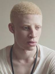 It is estimated that one out of every 18,000 to 20,000 people born in america each year has some form of albinism, according to the national organization for albinism and hypopigmentation. 180 Beautiful Black Albinos Ideas Albinism Albino Black Beauties