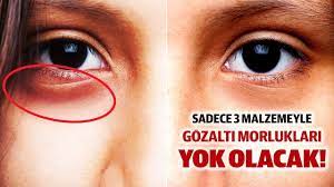 Goz Alti Morluklari Icin Maske Tarifi 3 Malzemeyle Yok Olacak Maskeler Gozler Dogal Cilt Bakimi