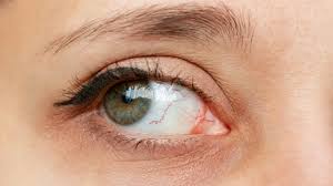 Image result for Keratitis