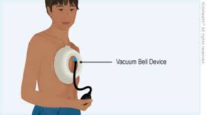 Pectus carinatum orthosis device designed by trulife. Pectus Excavatum Vacuum Bell Device For Parents Nemours Kidshealth