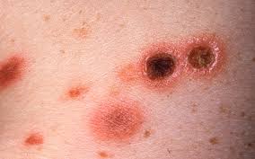Solar purpura is a harmless condition and is not related to skin cancer which is also associated with prolonged sun exposure. Purpuric And Hemorrhagic Disorders Plastic Surgery Key