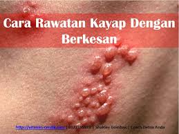 Tidak heran jika para hobiis rela menghabiskan banyak waktu, tenaga, dan uang untuk ikan hias yang. Cara Rawatan Kayap Dengan Berkesan Vitamin Cerdik By Coach Anah Ahmad