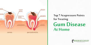 7 most effective acupressure points for treating gum disease