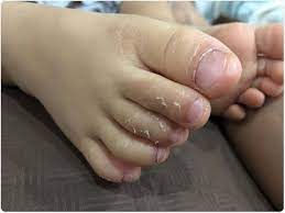 May 12, 2020 · the hallmark of kawasaki disease is a persistent high fever (over 101°f) for at least four days in addition to rash, redness to eyes, lips/tongue, swelling and redness to hands/feet and neck swelling. Kawasaki Disease Outbreak In Children With Covid 19