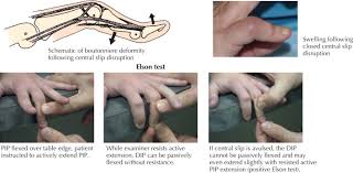 Image result for Elson Extensor Tendon Test