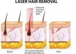 Delivering affordable and reliable laser hair removal services in fairfax, va is our core vision. Laser Hair Removal Chesapeake Va Dermacare Of Hampton Roads 1 757 317 3744