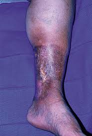 Image result for Lipodermatosclerosis