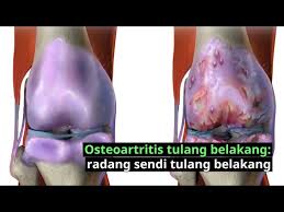 7,294 likes · 8 talking about this · 65 were here. Sakit Tulang Belakang Penyebab Dan Punca Doctoroncall