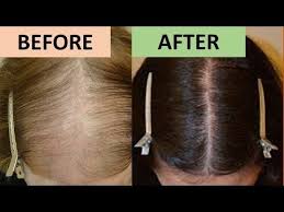 According to the nhs the most common type of hair loss is known as male and female pattern baldness, which is thought to be inherited. Pin On Hair Masks