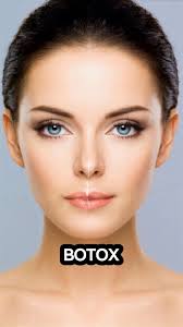 20 Units of Botox Before and After: See What This Popular Treatment Can  Achieve