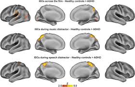 Get add and adhd information here including its causes, diagnosis, and promising treatments. Adhd Desynchronizes Brain Activity During Watching A Distracted Multi Talker Conversation Sciencedirect
