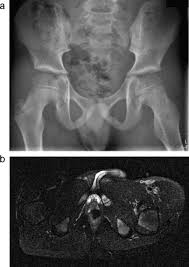 Pain caused by bone cancer usually begins with a feeling of tenderness in the affected bone. Bone And Soft Tissue Tumors Of Hip And Pelvis Sciencedirect