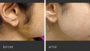 Cutting your hair with scissors is another option to get rid of sideburns. 7 Laser Hair Removal For All Skin Types Ideas Laser Hair Removal Hair Removal Skin