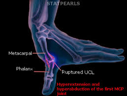 Subsequently requiring primary repair of the collateral ligament which resulted in good outcomes. Ulnar Collateral Ligament Injury Article