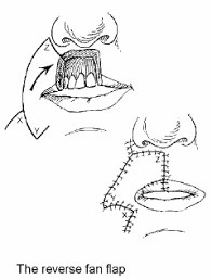 Fujimori r (1980) gate flap for the total reconstruction of the lower lip. Https Nanopdf Com Download Lip Reconstruction Pdf