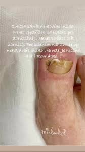 Image result for Akutní zánět nehtového lůžka